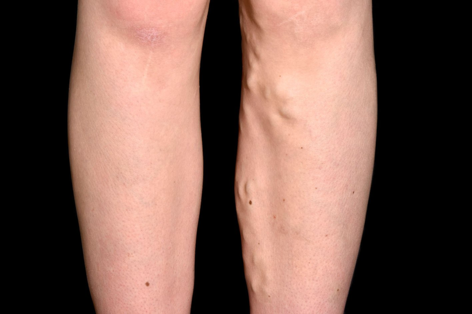 Varicose veins